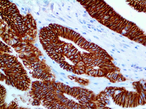 IHC of Li-Cadherin on an FFPE Colon Carcinoma Tissue